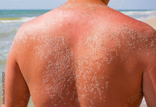 Dangerous sunburn on the sandy beach. Men with sun damaged peeling skin on the shoulders and back photo