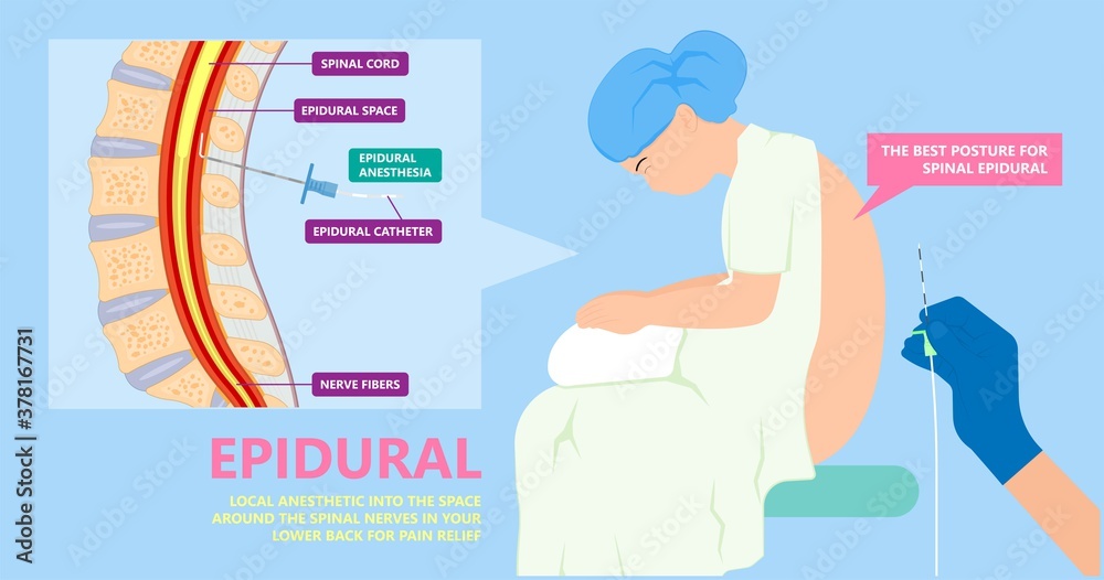 Epidural spinal block anaesthesia Pinched relieve General vaginal