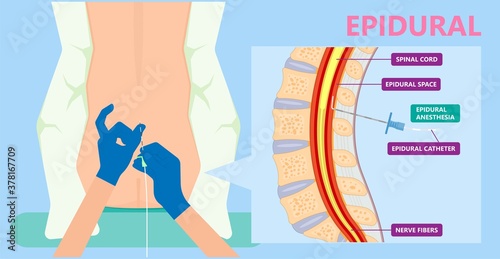 Epidural spinal block anaesthesia Pinched relieve General vaginal medical steroid Natural surgery Walking opioids baby pain back cord birth labor women local spine space relief labour section giving