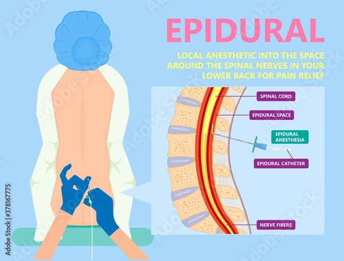 Epidural spinal block anaesthesia Pinched relieve General vaginal medical steroid Natural surgery Walking opioids baby pain back cord birth labor women local spine space relief labour section giving photo