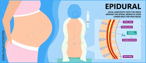 Epidural spinal block anaesthesia Pinched relieve General vaginal medical steroid Natural surgery Walking opioids baby pain back cord birth labor women local spine space relief labour section giving