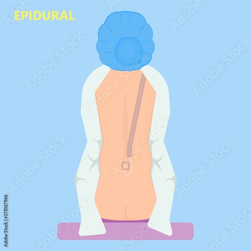 Epidural spinal block anaesthesia Pinched relieve General vaginal medical steroid Natural surgery Walking opioids baby pain back cord birth labor women local spine space relief labour section giving