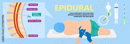 Epidural spinal block anaesthesia Pinched relieve General vaginal medical steroid Natural surgery Walking opioids baby pain back cord birth labor women local spine space relief labour section giving