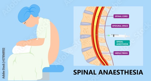 Epidural spinal block anaesthesia Pinched relieve General vaginal medical steroid Natural surgery Walking opioids baby pain back cord birth labor women local spine space relief labour section giving