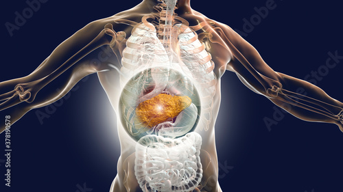 Liver with cirrhosis inside human body photo