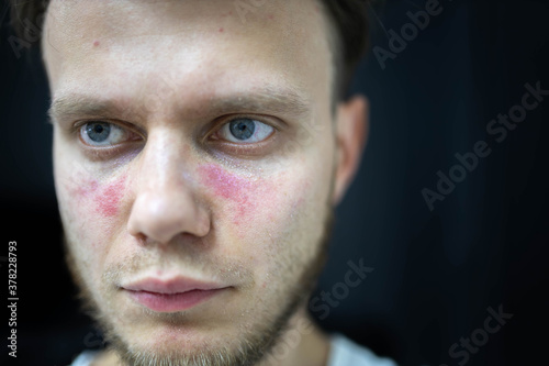 man suffers from systemic lupus erythematosus, age spots of redness on the face, a rash.