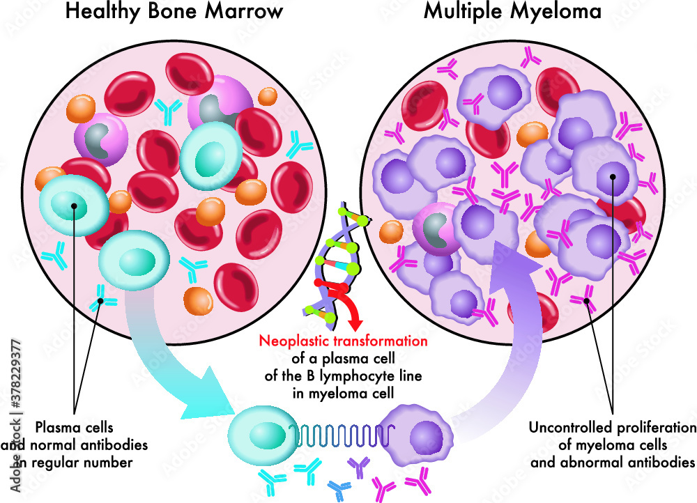 Medical illustration shows the transformation of plasma cells in