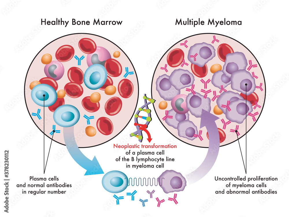 Medical illustration shows the transformation of plasma cells in