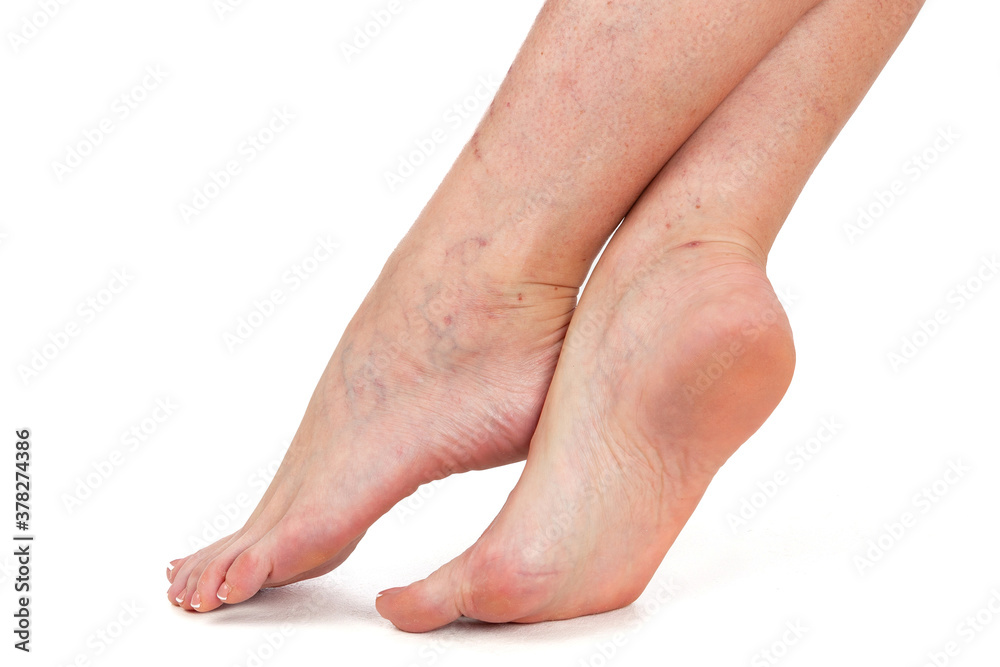 Legs of a woman. Skin with vascular stars. White background
