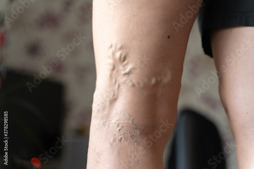 Varicose veins on woman legs indoors. Vascular health problem. Trombose on female legs © troyanphoto