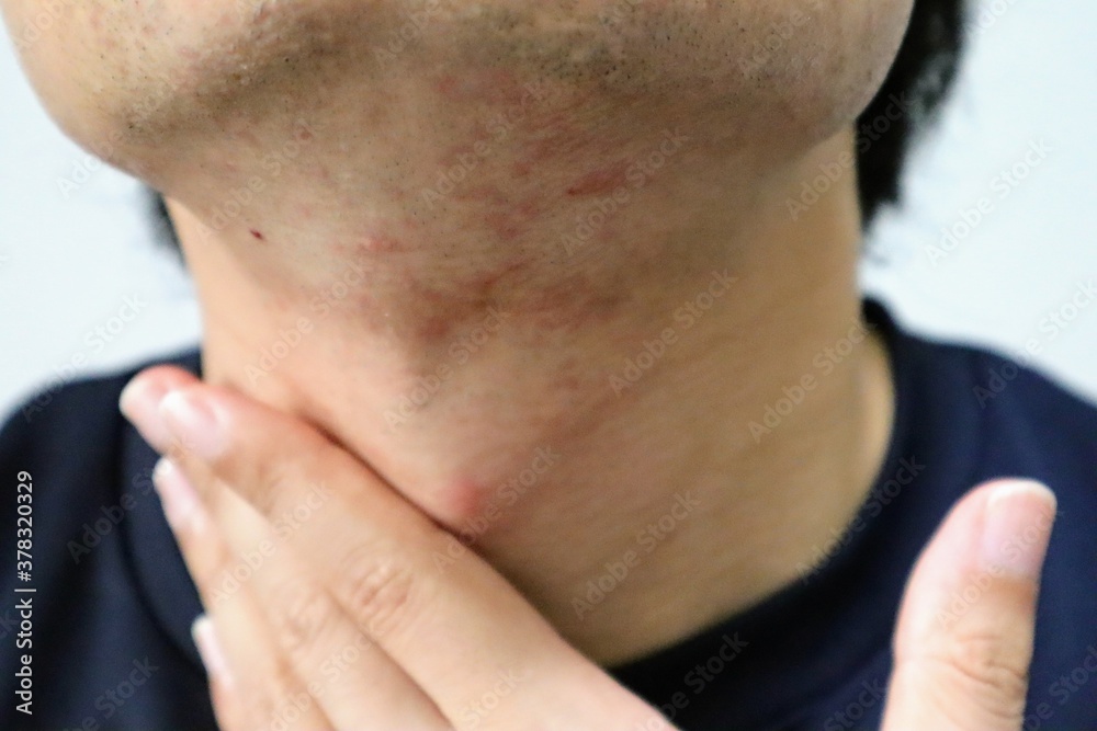 Naklejka premium 髭剃り後の肌荒れに悩む男性のクローズアップ