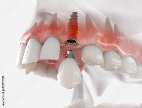 Replacement of maxillary canine with a dental implant. Realistic 3d illustration.