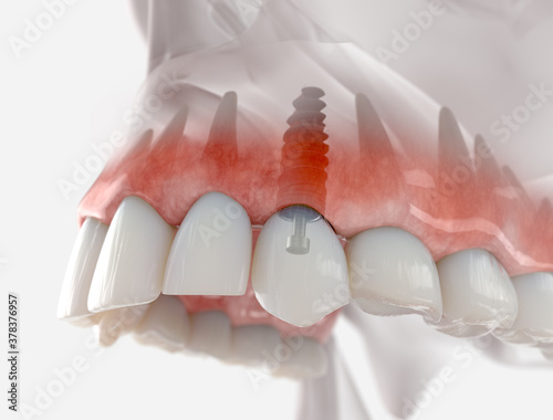 Replacement of maxillary canine with a dental implant. Realistic 3d illustration.