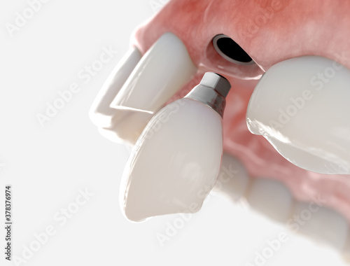 Replacement of maxillary canine with a dental implant. Realistic 3d illustration.