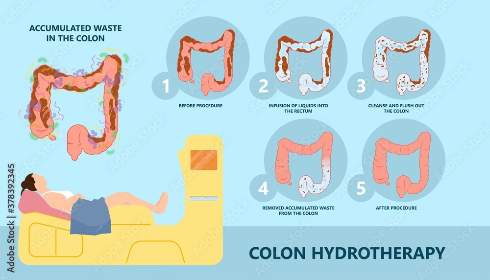 Vecteur Stock IBS IBD stool detox cleanse diets body water herbal cleansing  large Paradoxical Diarrhea Overflow liquid suppository relieve wast feces  Weight loss | Adobe Stock