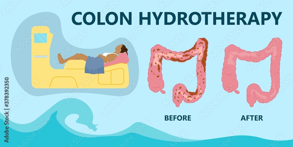 Naklejka premium IBS IBD stool detox cleanse diets body water herbal cleansing large Paradoxical Diarrhea Overflow liquid suppository relieve wast feces Weight loss