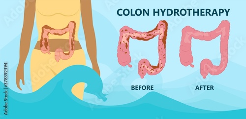 IBS IBD stool detox cleanse diets body water herbal cleansing large Paradoxical Diarrhea Overflow liquid suppository relieve wast  feces Weight loss