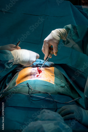  abdominal operation is performed in an operating room