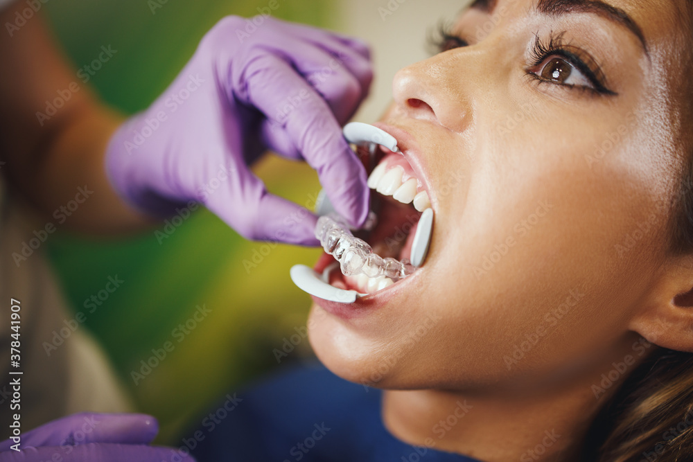 Indirect Bonding Aesthetic Lingual Braces Indirect Bonding Aesthetic Lingual Braces