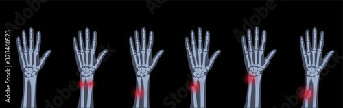 Fracture x ray concept