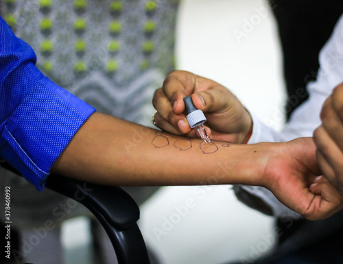 skin allergy test preparation by doctor on a patient hand using allergy sensitivity kit