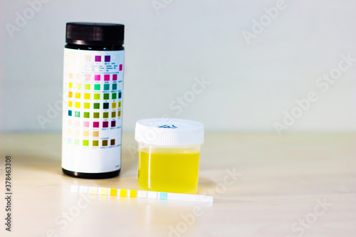 urine sample along with dip stick uristix for analyzing urine glucose protein in diabetes