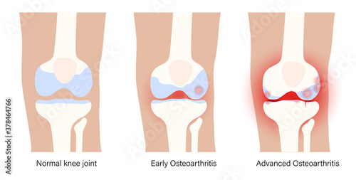 Arthritis in knee joint