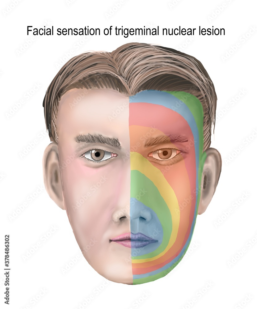 onion pattern of facial sensory loss caused by trigeminal nuclear lesion. ilustración de Stock