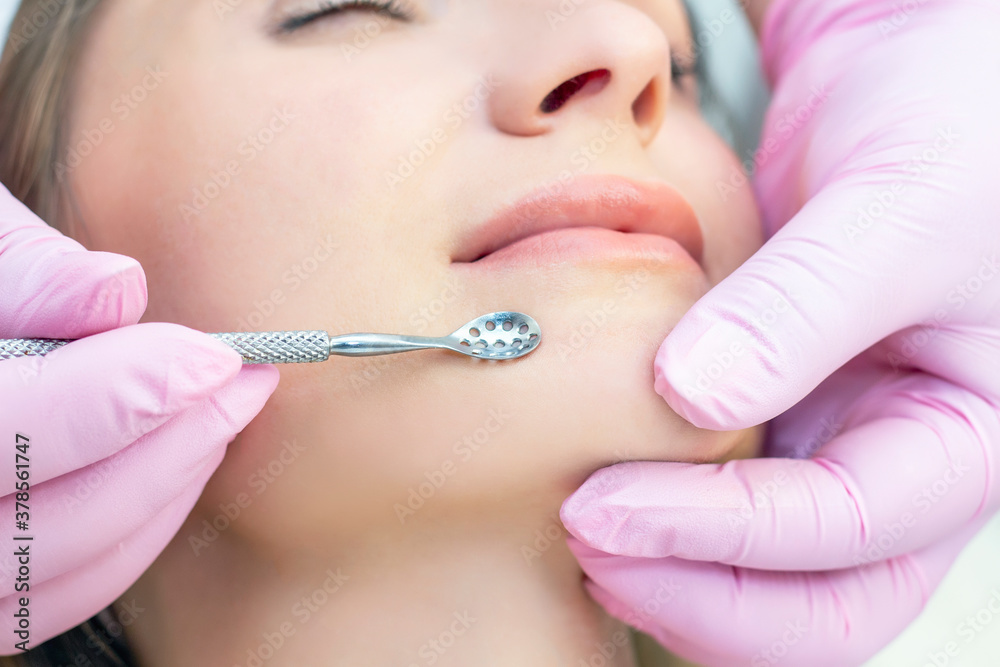 Procedure for cleaning the skin of the face with a steel appliance with a spoon from blackheads and acne. Procedure for cleaning the skin of the face with a steel appliance with a spoon from blackheads and acne.