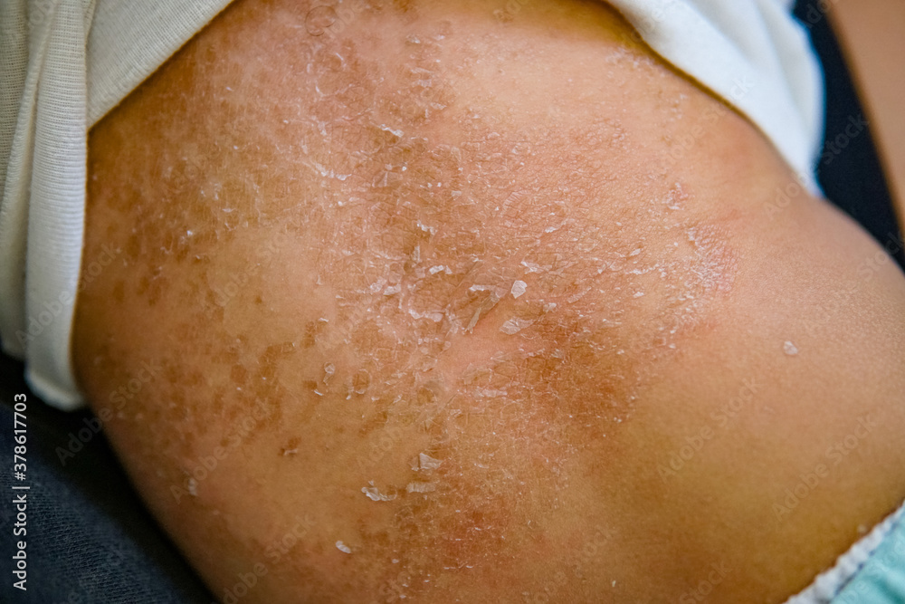 the skin on the back of the baby is red and peeling. asian baby. psoriasis. suitable for skin health purposes. shallow focus depth of field