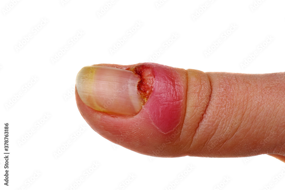 Female finger with panaritium on thumb finger. Isolated on white background Female finger with panaritium on thumb finger. Isolated on white background