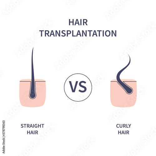 Hair transplantation for different hair types. Skin cross-section with straight and curly strands. Human hair growth style chart. Health care and beauty concept. Vector illustration.