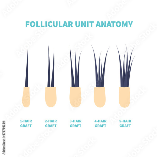 Hair micrograft classification set for hair transplantation surgery. Skin cross-section with number of hairs in the follicular unit or family. Hair science and anatomy. Cartoon vector illustration.