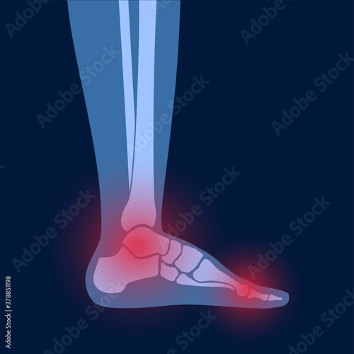 Arthritis foot concept
