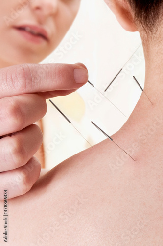 Acupuncturist applying needles on a person's back