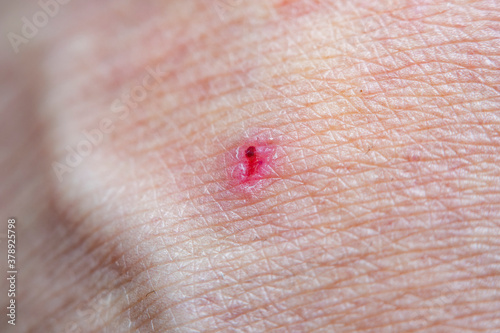 A close-up of a dried wound on human skin. A part of a man's leg with a wound that has healed after injury.