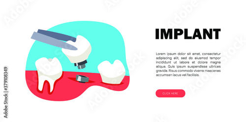 Dental implant banner with text.