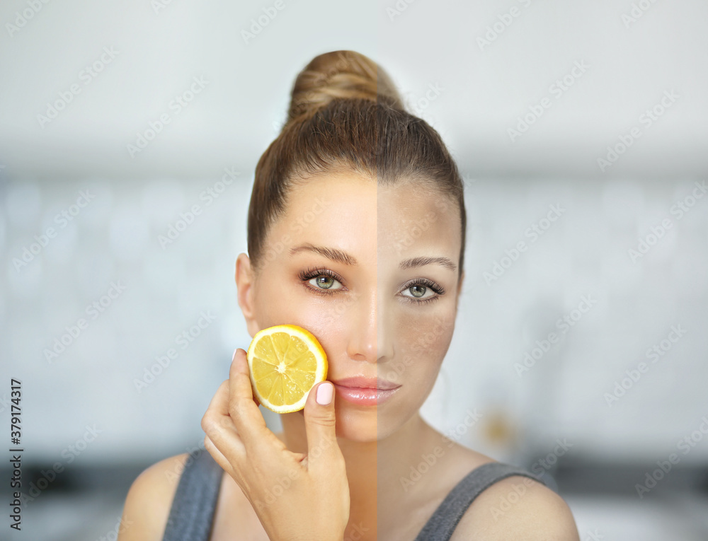 Dark spots, freckles,hyperpigmentation(melasma or chloasma),concept- skin lightening, skin whitening, Skin Brightening Dark spots, freckles,hyperpigmentation(melasma or chloasma),concept- skin lightening, skin whitening, Skin Brightening