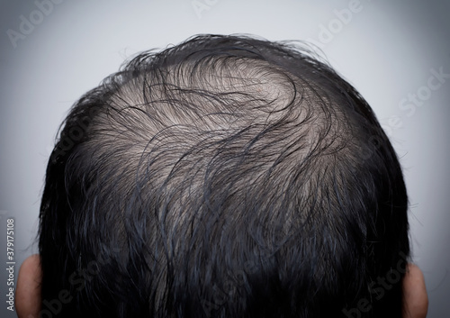 Bilde på lerret Close up man's head with hair loss, thinning hair or alopecia isolated on white background