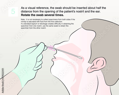 Step 5 : As a visual reference, the swab should be inserted about half the distance from the opening of the patient’s nostril and the ear. Rotate the swab several times.