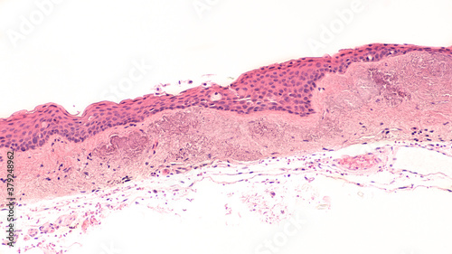 Photomicrograph of a pterygium of conjunctiva, with prominent degenerative changes of solar elastosis, related to exposure to ultraviolet (UV) light.  photo