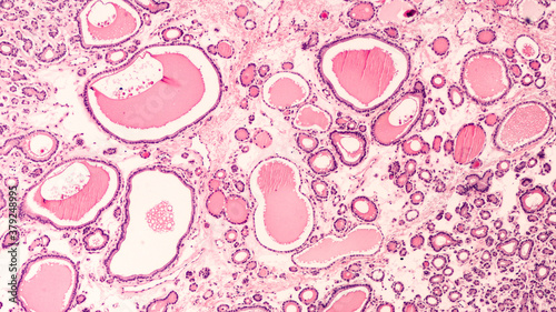 Photomicrograph showing histology of a benign thyroid nodule in a patient with multinodular goiter.  Follicles of varying size are seen, many filled with colloid material. photo