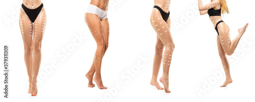 Cellulite removal plan. The black markings on young woman body preparing for plastic surgery. Concept of body correction, beauty, surgery procedure, liposuction. Fit female body. Copyspace.