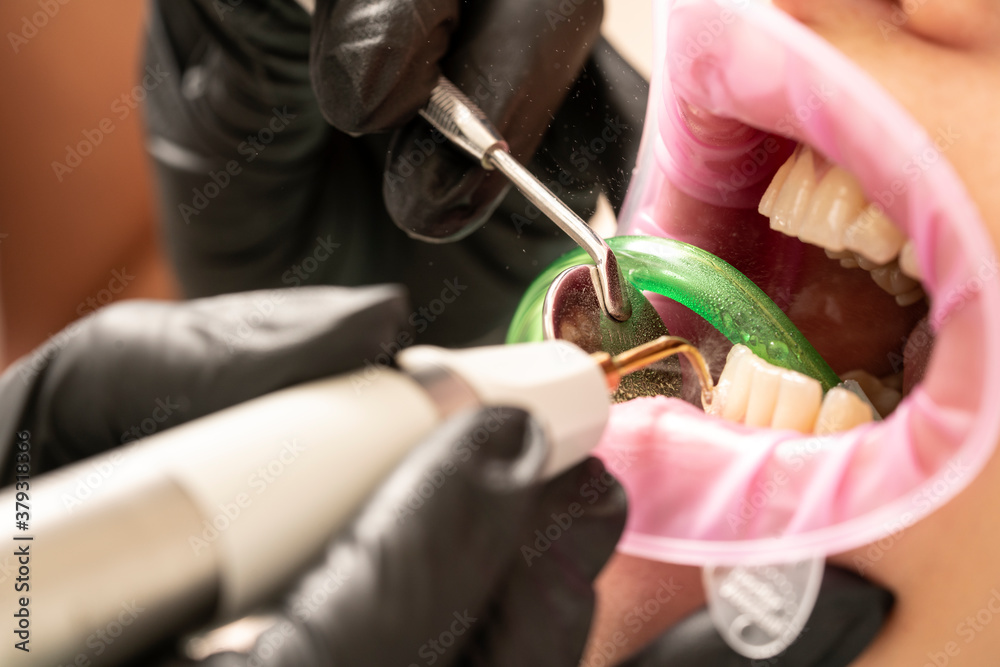 Dental calculus plaque remover tool