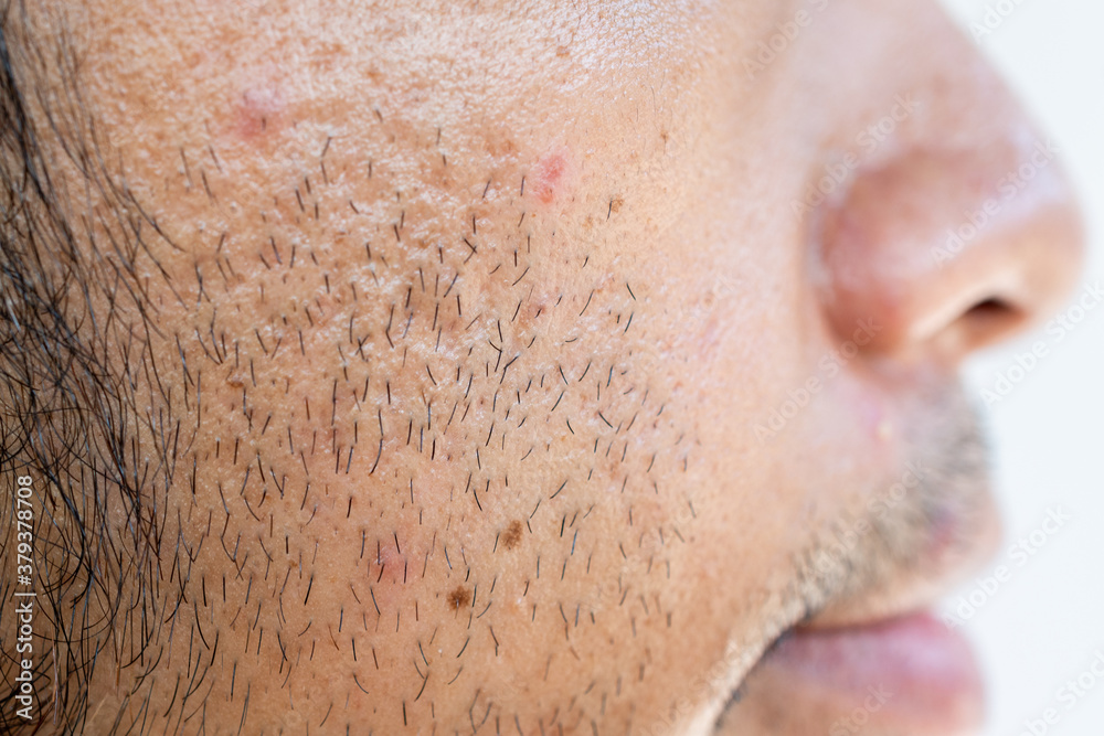 Side view of facial hair grown on men's cheek. Facial hair is hair grown on the face. Side view of facial hair grown on men's cheek. Facial hair is hair grown on the face.