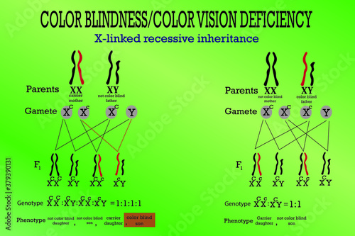 Color blindness genetics on X chromosome. X-linked gene  