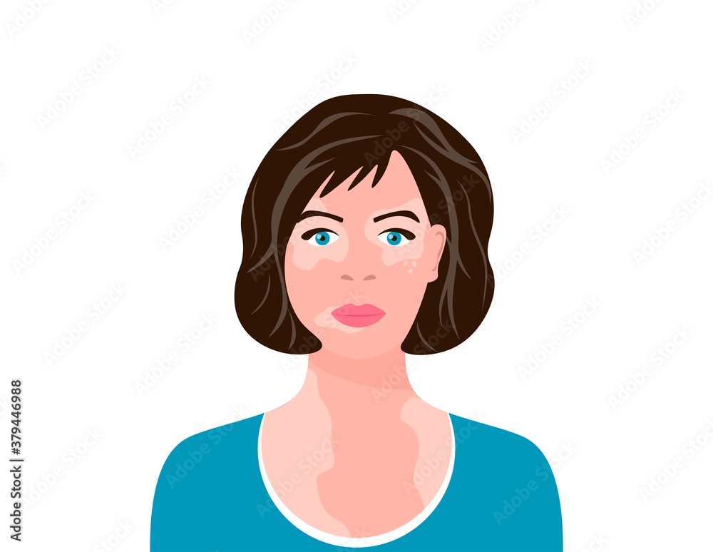 Young woman with vitiligo. Close-up portrait of a woman with skin problems. Female character with vitiligo. Vector illustration on white isolated background. Young woman with vitiligo. Close-up portrait of a woman with skin problems. Female character with vitiligo. Vector illustration on white isolated background.
