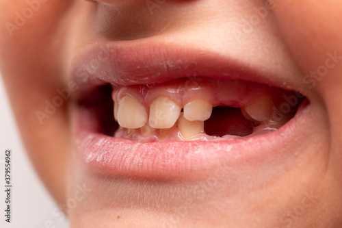 a baby's mouth with a missing milk tooth