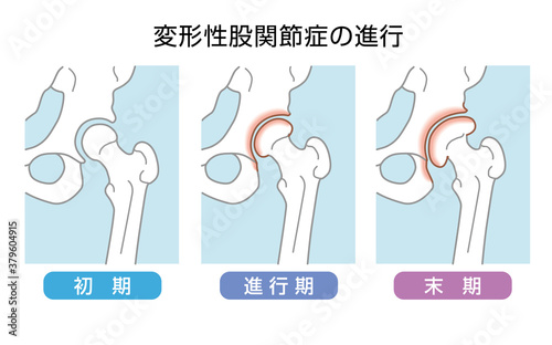 変形性股関節症の進行 photo