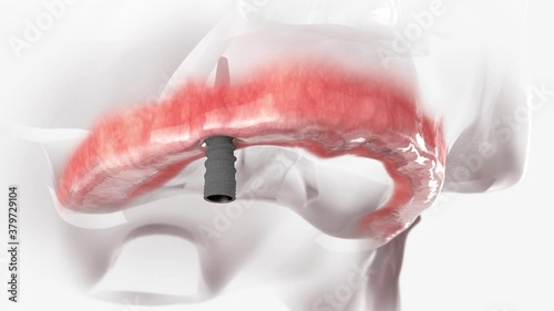Full arch dental prosthesis of the upper jaw.